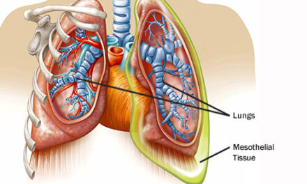 A Brief Overview Of Mesothelioma in 2024
