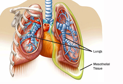 A Brief Overview Of Mesothelioma in 2024