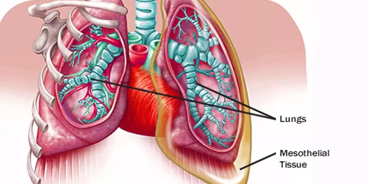 Symptoms and signs of Mesothelioma in 2024