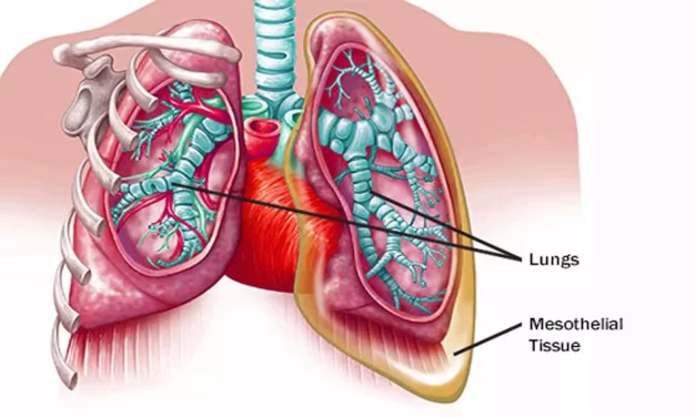 Symptoms and signs of Mesothelioma in 2024